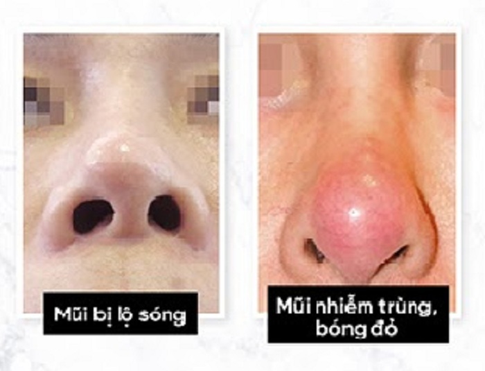 Nâng mũi bọc sụn - giải pháp tránh bóng đỏ đầu mũi