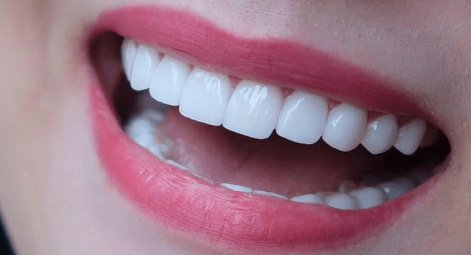 bọc răng sứ đẹp
